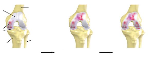 Belauneko artikulazioaren artrosiaren maila