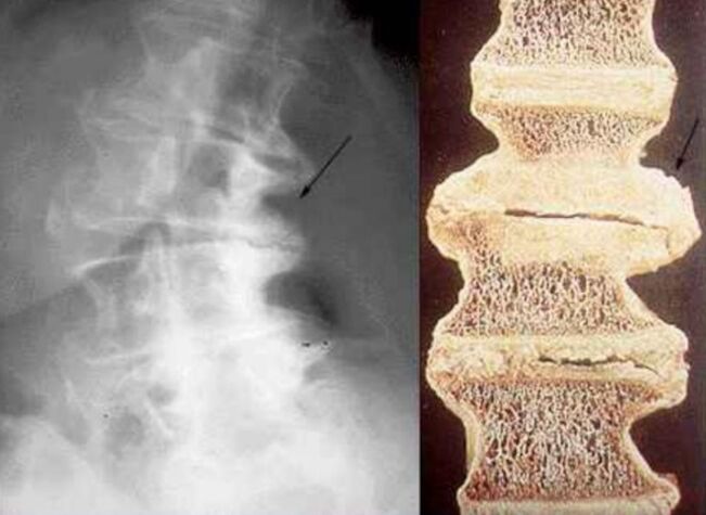 ornoetan kalteak osteokondrosi torazikoan