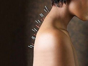 Erreflexoterapia zerbikaleko osteokondrosia tratatzeko metodo eraginkorra da